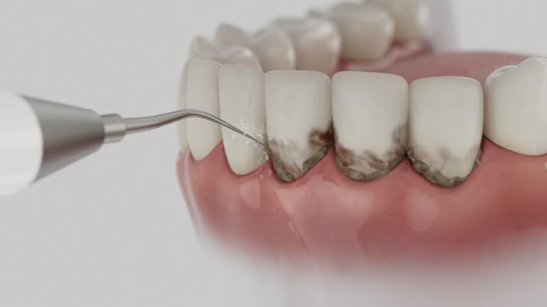 Trusted Invisalign Clear Aligners service in Milledgeville, GA - Dentist Open Now